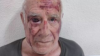 Foto de Domingo, tras la agresión del 9 de julio de 2025 en Torre Pacheco, viralizada en redes.